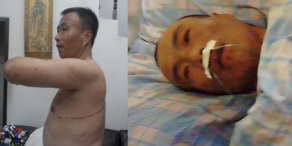 Cheng Peiming hat den Organraub in China überlebt und zeigt die Narben der erzwungenen Operation. Foto: minghui.org